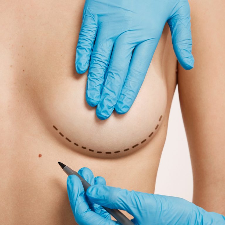 breast-augmentation-5