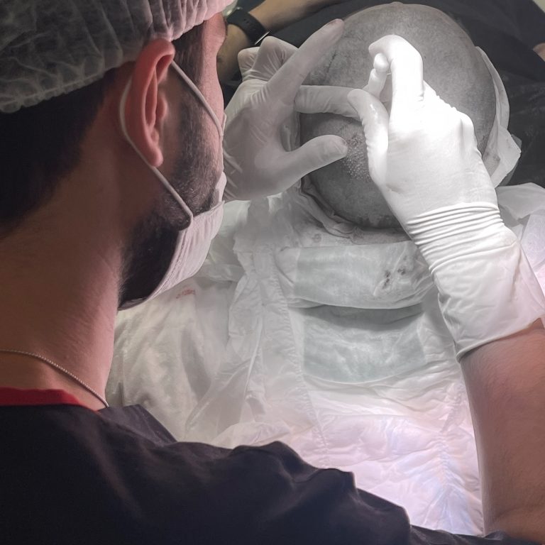 dhi-hair-transplant